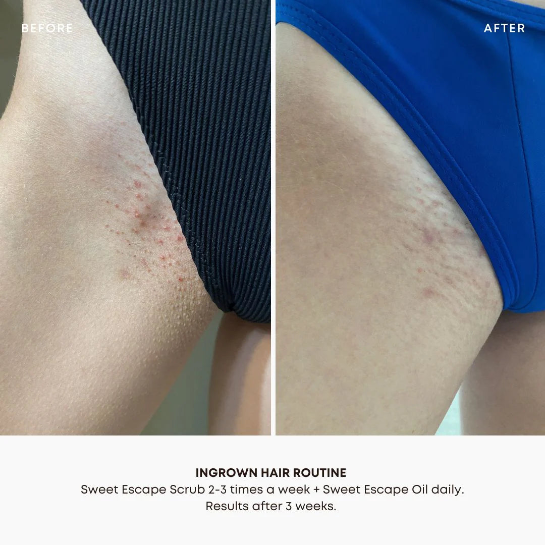 Ingrown hair exfoliating body scrub Sweet escape