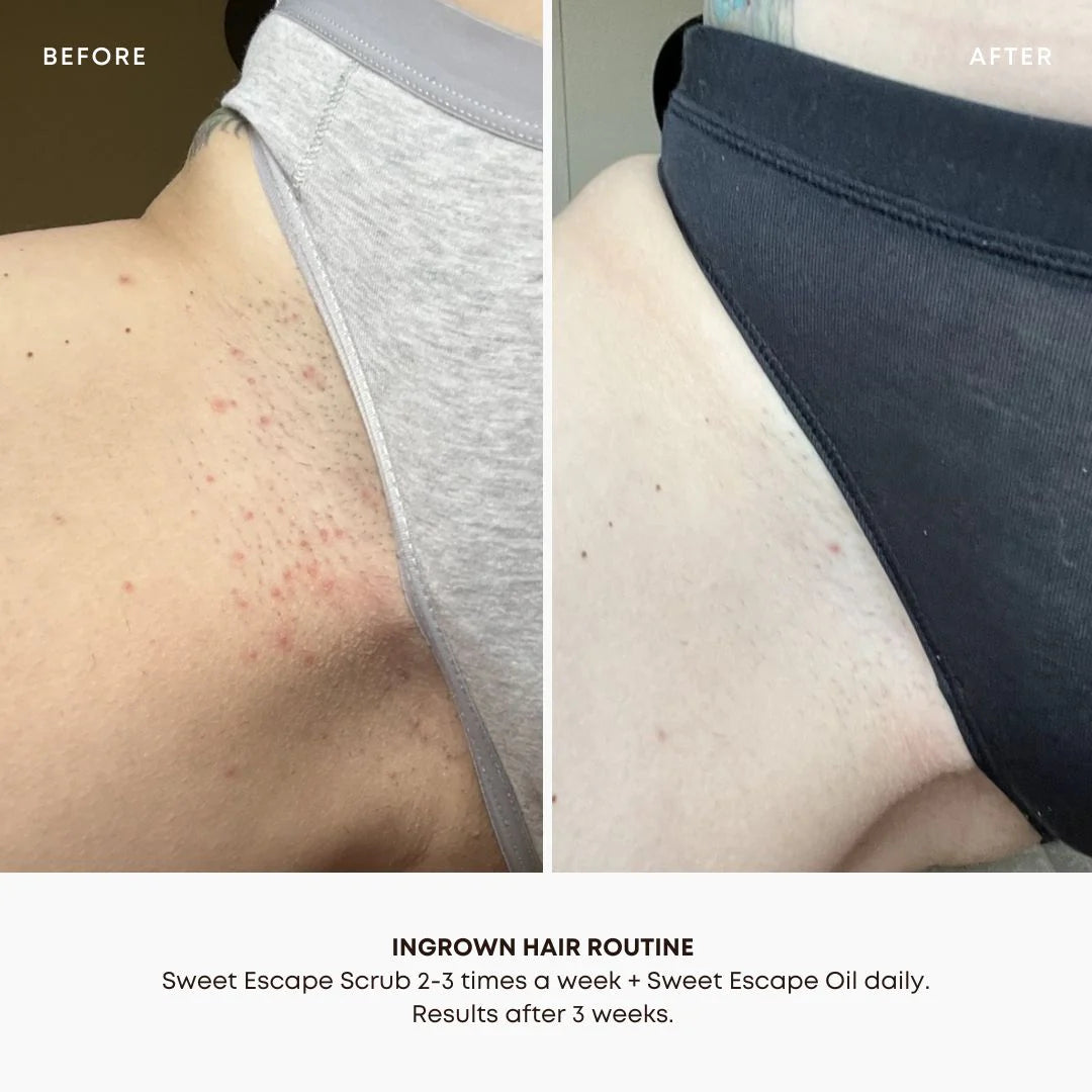 Ingrown hair exfoliating body scrub Sweet escape