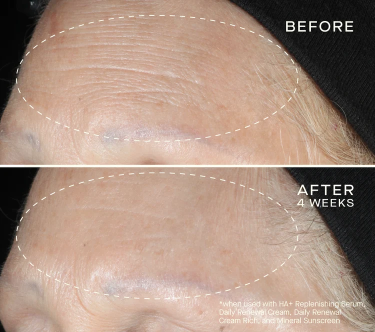 Pre-order VOLUME RECOVERY SET with Tiered-Release Vesicle™ Technology ($315 value)